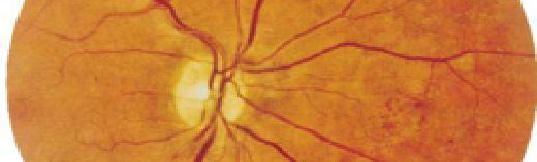 normal retinal image (a) Input Image (b) Gray