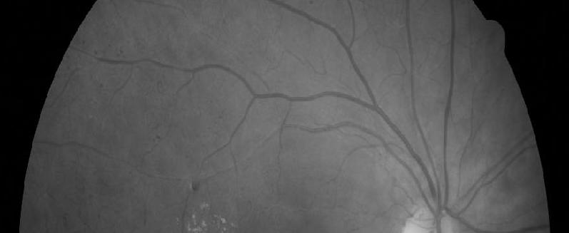 patients with diabetic retinopathy and 15