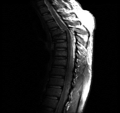 Power-law transformati on Fractured_spine image When gamma=2 in powerlaw histogram of