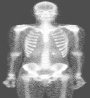 Before histogram Equalization of Partial body Partial body scan image After