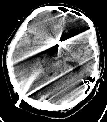 First row: FBP image (curved planar reformat) shows left hydroureteronephrosis.
