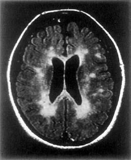 Fig. 14.5 A T2 weighted fast FLAIR image of the brain using TE 140 ms, TR 4600 ms and TI 1750 ms.