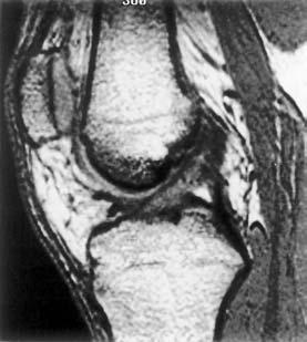 B 0 small flip angle no saturation can occur small transverse component of magnetization signal intensity Fig. 15.6 A sagittal T1/proton density weighted image of the knee.