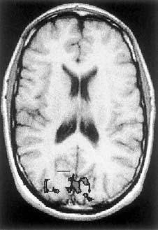Fig. 20.4 This axial view of the brain was acquired for anatomical information. The irregular area overlaid on the posterior brain is the BOLD acquisition during visual stimulation.