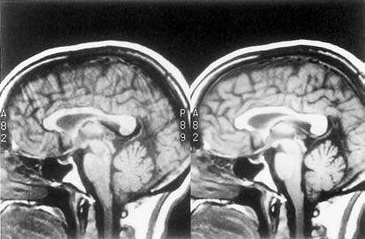 Fig. 28.3 Sagittal images of the brain. The image on the left used partial averaging and took 56 s to acquire.