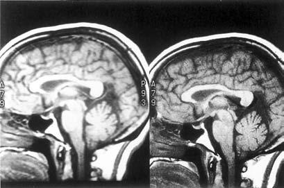 Fig. 30.3 Sagittal images of the brain. The image on the left was acquired with a matrix of 256 128, whereas the image on the right was acquired with a matrix of 512 256.