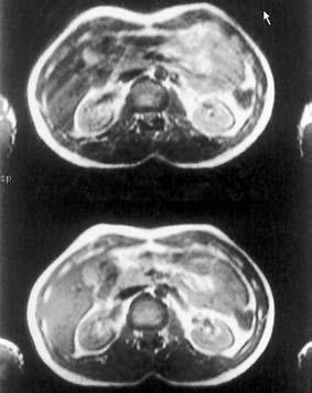 The ghosting (arrow), has been reduced on the lower image. Fig. 36.2 Coronal FSE T1 weighted images through the temporal lobes. The image on the left has the phase encoding axis R to L.