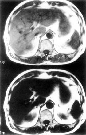 Fig. 36.5 Sagittal T1 weighted incoherent (spoiled) GRE with spectral pre-saturation before (left) and after (right) contrast enhancement. Fig. 36.4 Axial T1 weighted images of the abdomen without water presaturation (above), and with water pre-saturation (below).