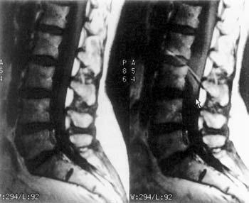 37 Phase wrap/aliasing FOV axial slice through the abdomen Y X phase encoding axis Fig. 37.1 X and Y have the same value of phase. Y X Fig. 37.3 Sagittal T1 weighted images of the lumbar spine.