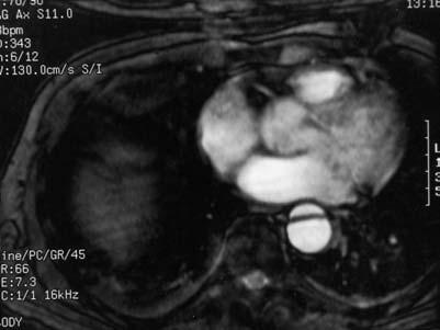 Fig. 38.6 Axial coherent GRE T2* cine image of the heart and great vessels using bright blood imaging.