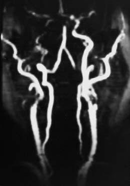 39 Time of flight angiography (TOF-MRA) Fig. 39.2 3D TOF-MRA in a 4-year-old child showing normal appearances. Fig. 39.1 Coronal triggered 2D TOF-MRA through the carotids and bifurcation.