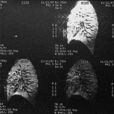 Clinical applications This is mainly used in liver imaging where normal liver is dark on T2 weighted images and lesions appear bright (Fig. 42.4).