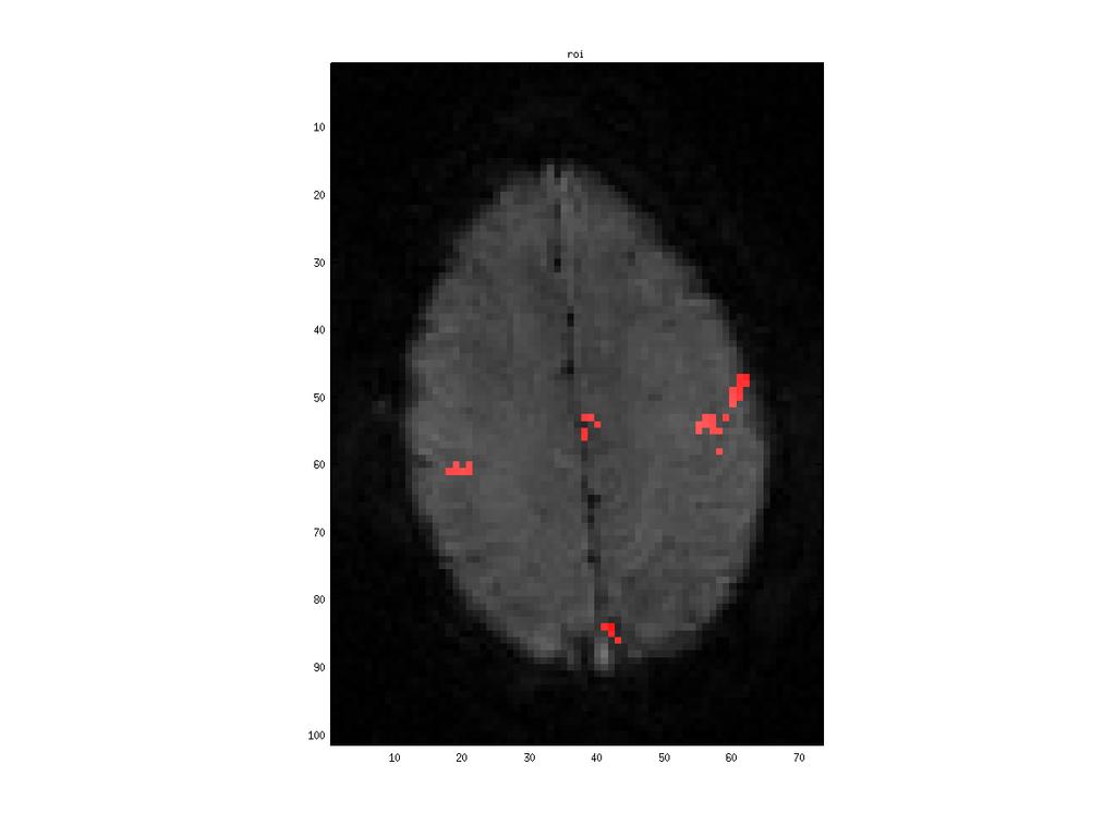 (a) BOLD Rep 1 Rep 2 Rep 3 Rep 4 Rep 5 STFR bssfp (b) (c) Figure 4.3: Repeated motor cortex imaging using STFR, BOLD and bssfp in one subject (A, Session 1).