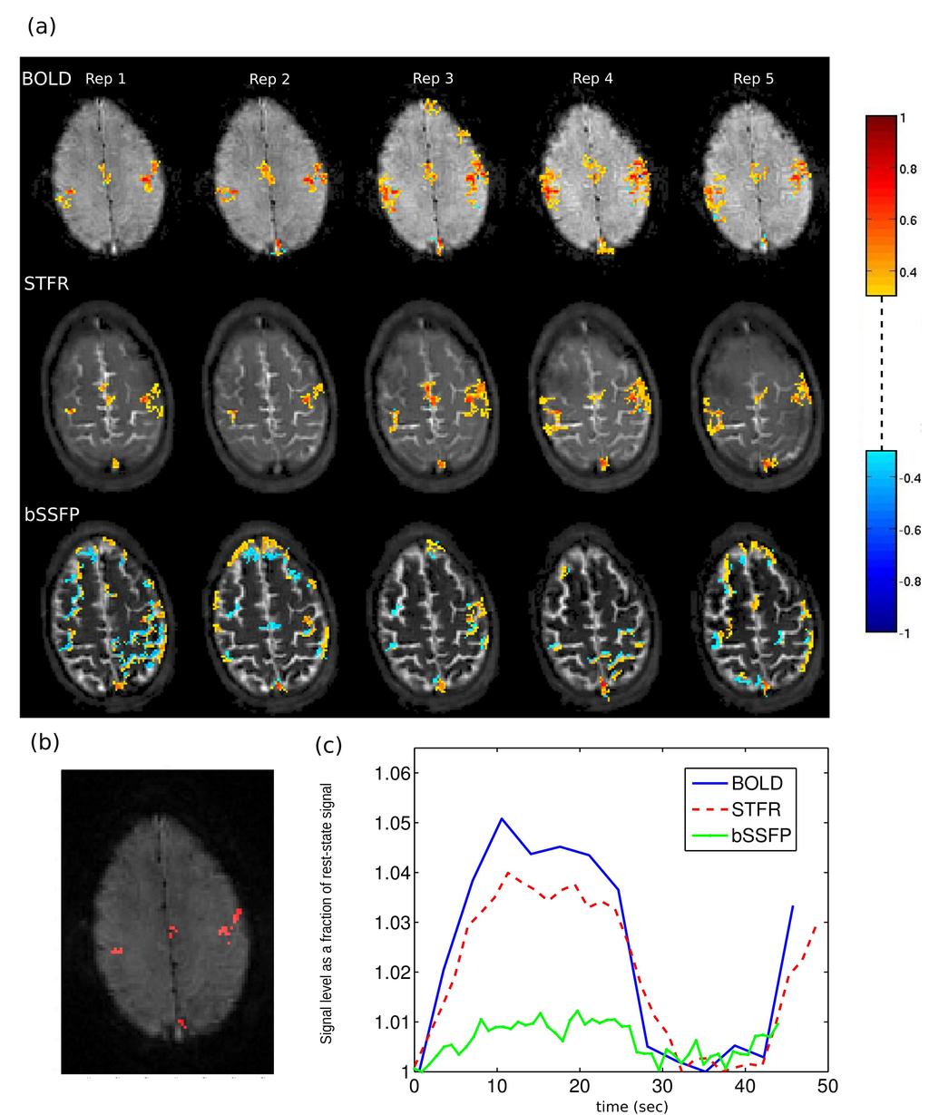 All five scans demonstrate that STFR can produce similar activation maps as BOLD, which are well localized to the motor cortex area.
