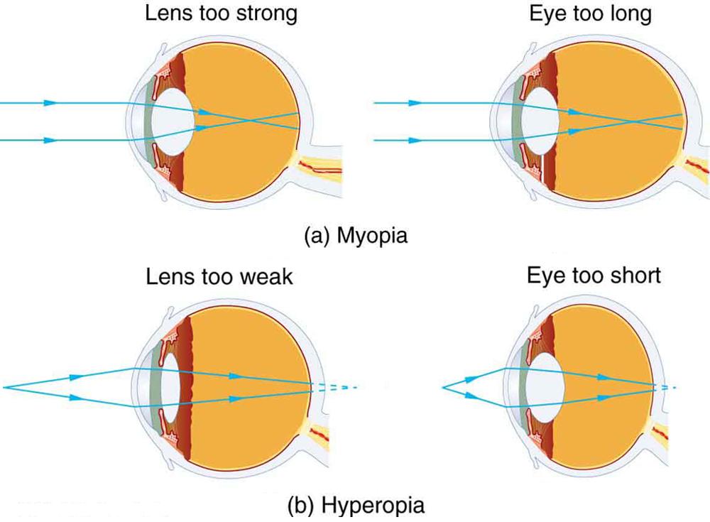 OpenStax-CNX module: m42484 2 Figure 1: (a) The nearsighted (myopic) eye converges rays from a distant object in front of the retina; thus, they are diverging when they strike the retina, producing a