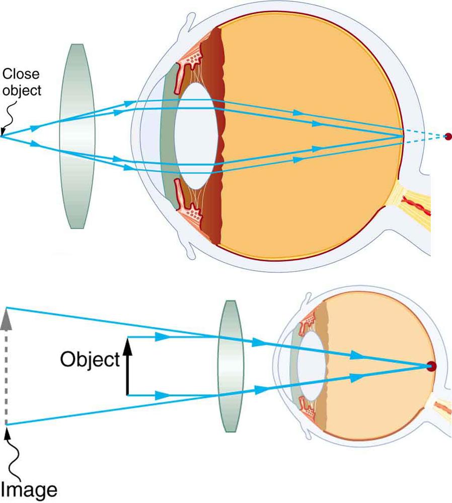 OpenStax-CNX module: m42484 5 Figure 3: Correction of farsightedness uses a converging lens that compensates for the under convergence by the eye.