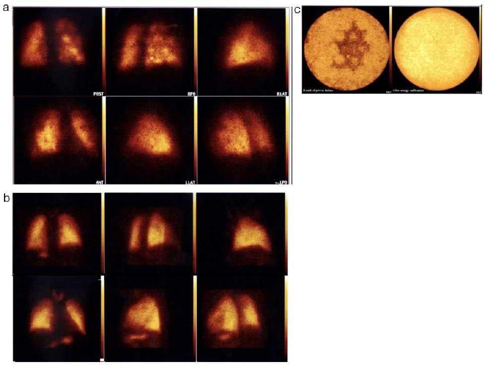 I.1 THE ART OF TROUBLE-SHOOTING I.1.2 Processes in trouble-shooting Abnormal pattern Patchy pattern (a) found on the lung scans due to untuned camera, confirmed by QC test (left c).