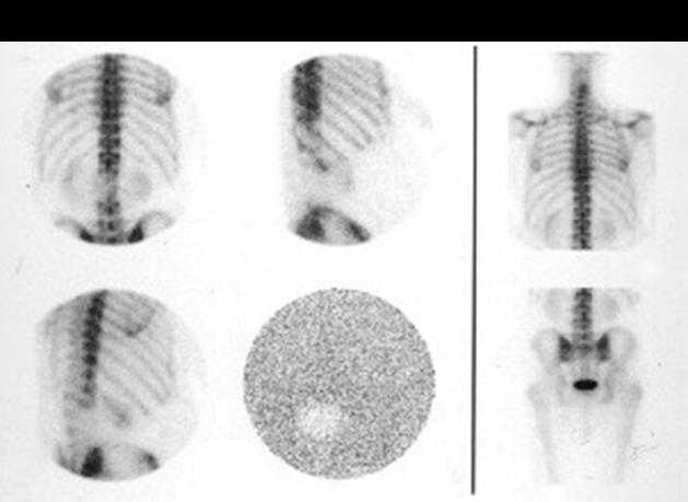 I.2 IMAGE ARTEFACTS I.2.1 Recognizing image artefacts and their underlying causes Uniformity defect due to PMTs In camera A an area of apparent decreased activity is observed in the lower spine.