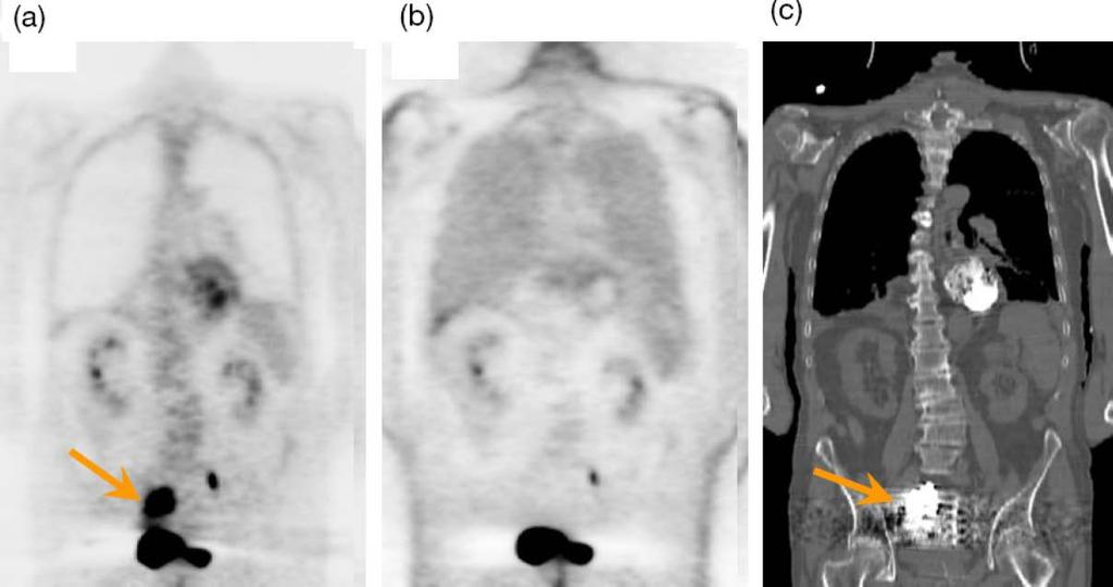 I.4 IMAGE ARTEFACTS IN PET/CT I.4.2 Attenuation correction artefacts Attenuation correction artefact (a)ct attenuation corrected image of a patient showing a focal hot spot (indicated by the arrow).