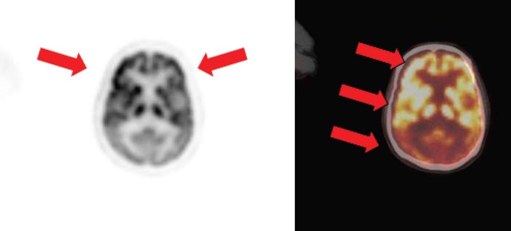 I.4 IMAGE ARTEFACTS IN PET/CT I.4.3 Co-registration and motion artefacts Misalignment artefact Apparent asymmetrical uptake of [ 18 F]-fluorodeoxyglucose in the