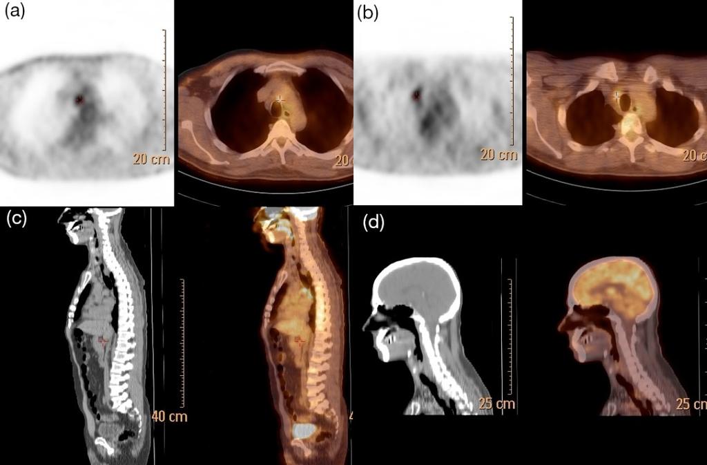 I.4 IMAGE ARTEFACTS IN PET/CT I.4.3 Co-registration and motion artefacts Mis-registration artefact (a)a whole body PET/CT scan shows a point of focal uptake in the upper torso.