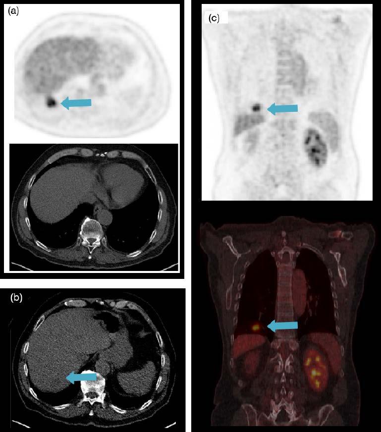 I.4 IMAGE ARTEFACTS IN PET/CT I.4.3 Co-registration and motion artefacts Respiratory motion artefact (a)transaxial PET and CT images show a focal lesion, which appears to be in the lung.