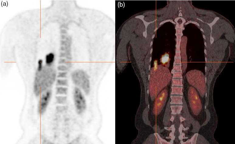 I.4 IMAGE ARTEFACTS IN PET/CT I.4.3 Co-registration and motion artefacts Mis-registration artefact (a)coronal PET image shows an area of focal uptake that appears to be both in the liver and in the