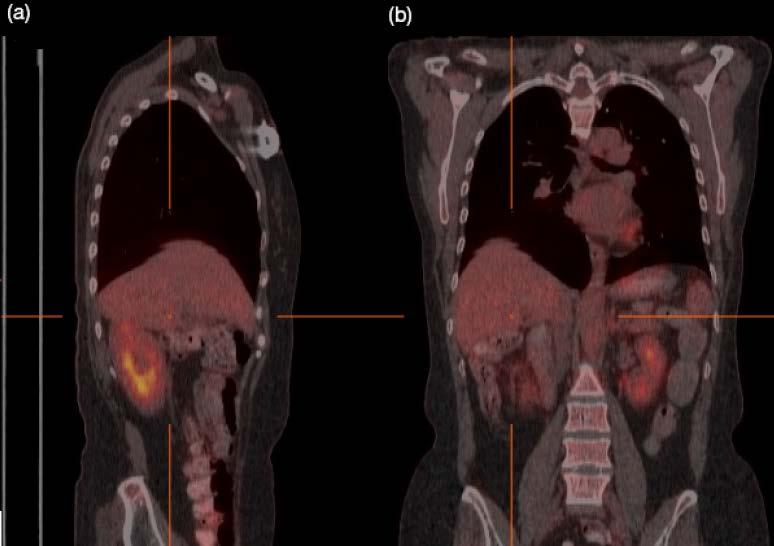 I.4 IMAGE ARTEFACTS IN PET/CT I.4.3 Co-registration and motion artefacts Respiratory motion artefact (a)sagittal image shows a step-like artefact in the liver.