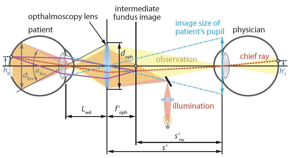 22 Indirect Ophthalmoscope Pupil mismatch between patient and observer reduces field of view in direct ophthalmoscope Indirect
