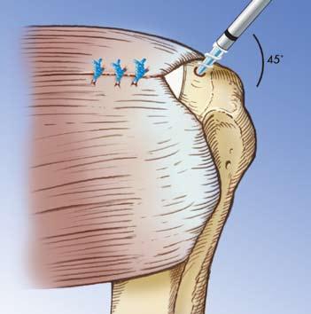 Bio-Corkscrew Suture Anchor Rotator Cuff Repair