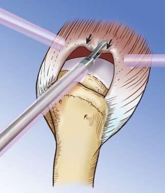 The medial apex of the tear is grasped and pulled laterally to assess the medial-to-lateral mobility of the tear, which in this case is minimal.
