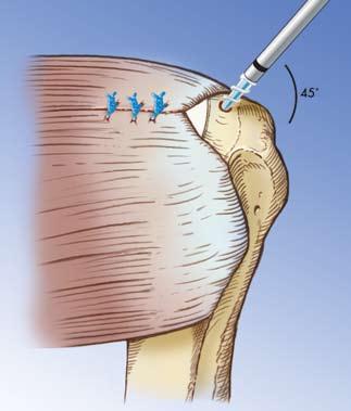 The Bio-Corkscrew is inserted at a 45 degree deadman angle to maximize resistance to pull-out. 11 12 The Scorpion Suture Passer is used for passing the sutures through the rotator cuff.