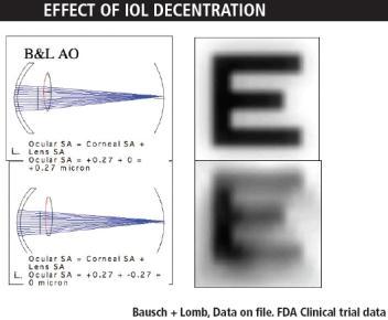 IOL with negative spherical aberration (Tecnis)