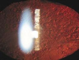 POSTOPERATIVE Dry eye. PCO, capsular phimosis. IOL decentration. Toric IOL rotation. Macular dysfunction: DME, CME.