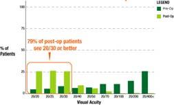 Pre and post-op op uncorrected near visual acuity 6-WEEK FU VS PRE-OP Spectacle independence of patients Pre-op