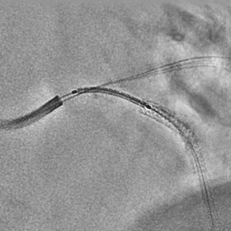 SCORE StentView PCI Stent Placement Support Application PCI sometimes requires a stent or other device to be positioned accurately during cardiac motion.