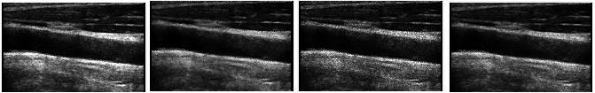 A new Speckle Noise Reduction Technique to Suppress Speckle in Ultrasound Images 351 HMMF [6] NMCA [9] AMF [10] PROPOSED Figure 7. Result of ultrasound nerve tumour image.