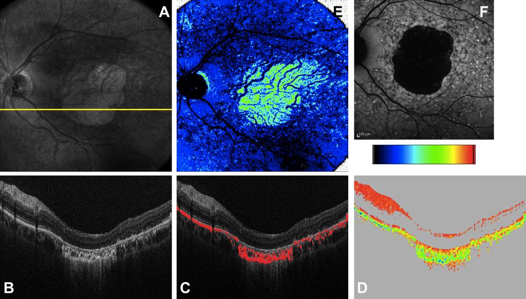 Fig. 7. PS-OCT measurement result from a patient with GA and drusen. (A) Pseudo SLO image; yellow line indicates the position of the intensity (B). (C) RPE segmentation B-scan and (D) DOPU image.