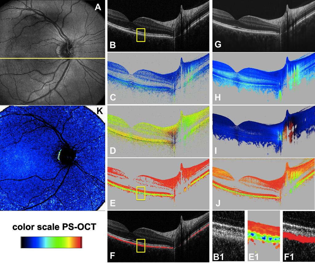 In order to detect atrophic zones in dry AMD we simply add the number of depolarizing pixels along each A-scan within the 3D PS-OCT data set.