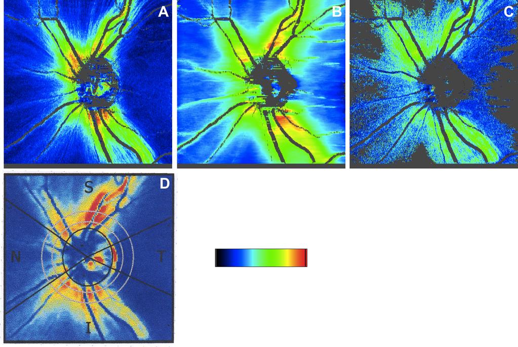Fig. 4. Averaged RNFL retardation (A) (color scale 0-50 ), thickness (B) (color scale 0-200 µm) and birefringence (C) (color scale 0-0.