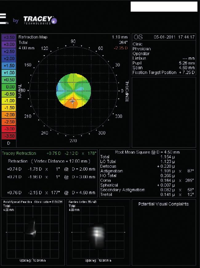 With this system we can go further and analyse exactly where the astigmatism shown in the total refraction comes from.
