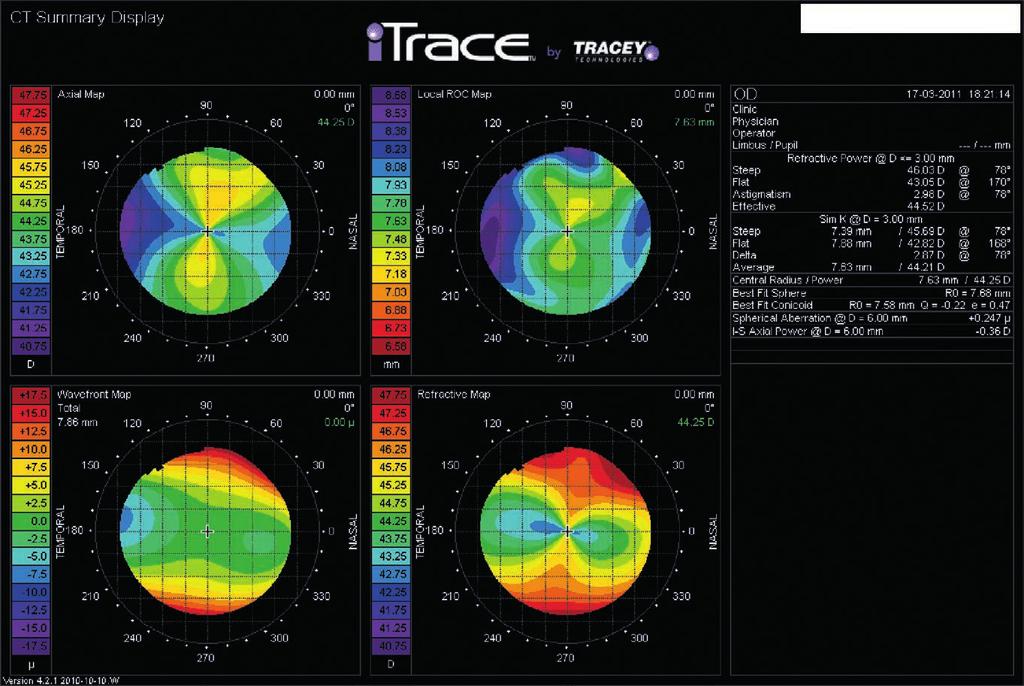 164 PRINCIPLES AND CLINICAL APPLICATIONS OF RAY-TRACING ABERROMETRY (PART II) Phakic lens A 29-year-old patient with refraction in her RE of 9.00 ( 6.00) 175 and VA 0.4. We analysed topography using CT, detecting corneal astigmatism of nearly 3.