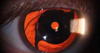 POSTOPERATIVE FOLLOW-UP A conventional cataract surgery follow-up