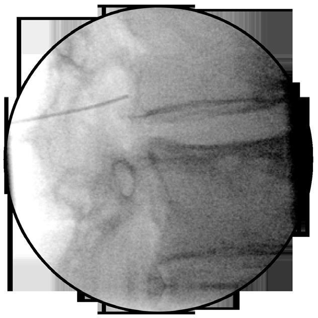 5 superior articular The Blunt Needle tip should enter the neural foramen with enhanced safety as it s design is less likely to penetrate through nerves or arteries.