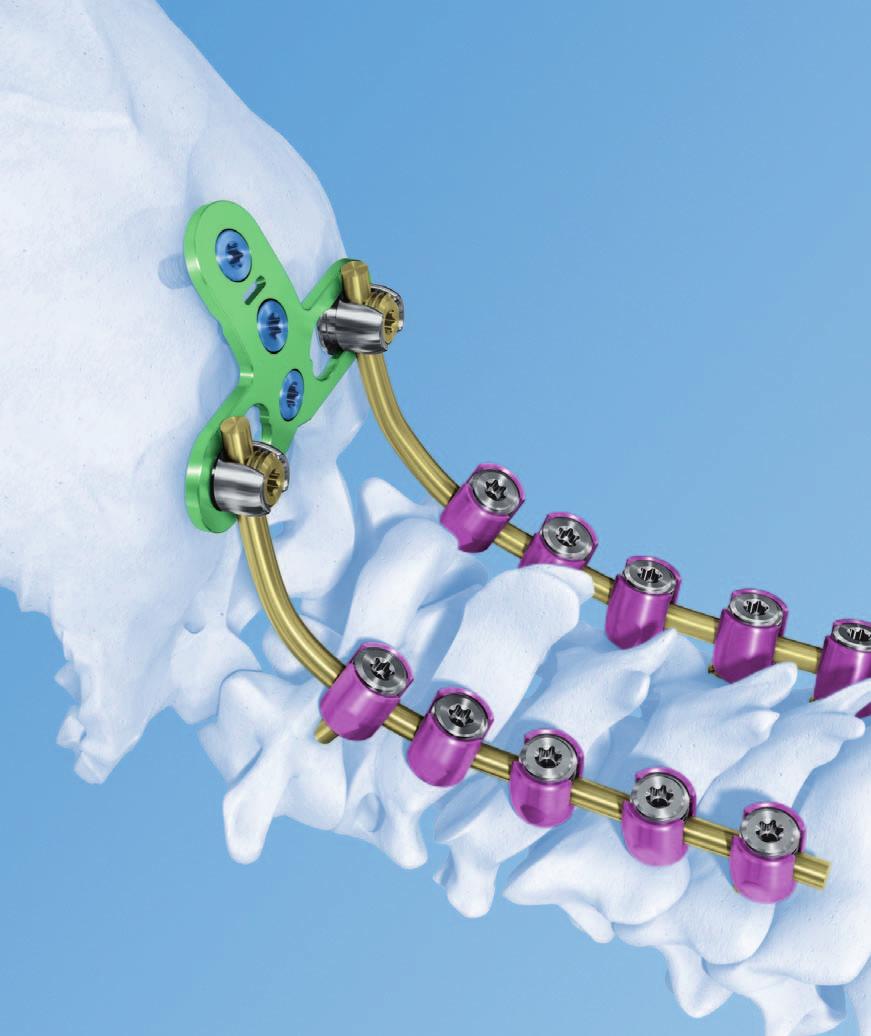 Occipito-Cervical Fusion System. Implants and instruments designed to optimize fixation to the occiput.