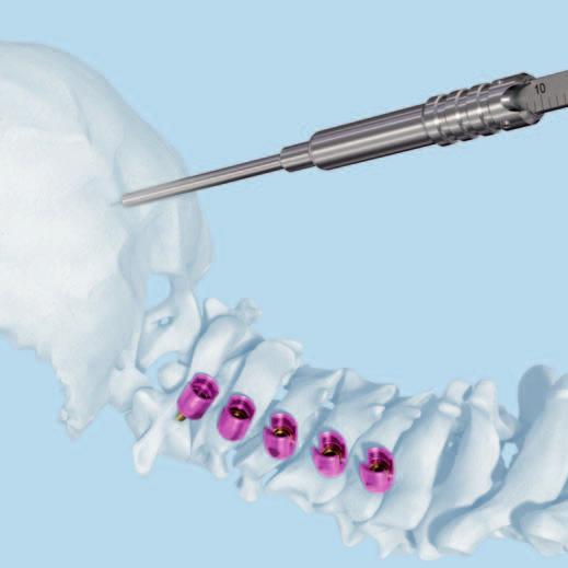 Occipito-Cervical Fixation with Occipital Plate 5 Measure hole depth Instrument 03.161.028 Depth Gauge for Screws 3.5 to 5.