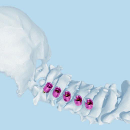 Occipito-Cervical Fixation with Occiput Rods Shown in combination with Synapse; can also be used with Axon or CerviFix 1 Fixation to the cervical and upper thoracic spine Recommended set 01.614.
