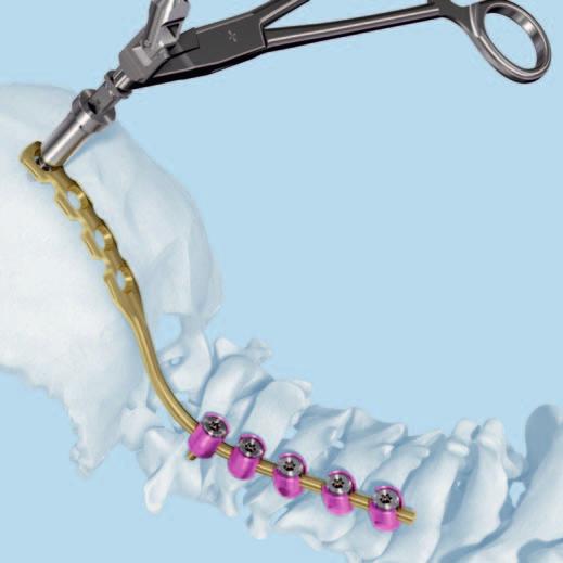 Occipito-Cervical Fixation with Occiput Rods Optional instruments 03.161.027 Tap for Cortex Screw 4.5 mm, with Cardan Joint, length 245 mm, for Quick Coupling 388.407 Holding Forceps for Rods 3.