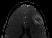 Contrast Enhanced imaging Angiography Higher SNR Longer tissue T1