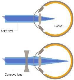 Corrective Lenses (what type of lens fixes what?
